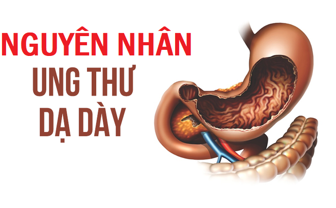 Những nguyên nhân phổ biến dẫn đến ung thư dạ dày 