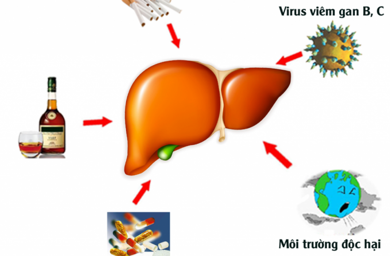 6 nguyên nhân gây ung thư gan thường gặp